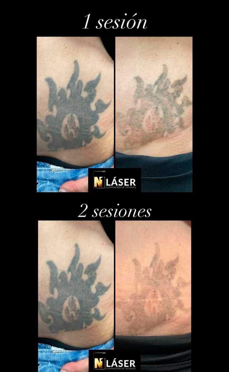 Eliminar Tatuaje Abdomen