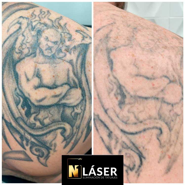 Eliminar Tatuaje De Demonio En La Espalda